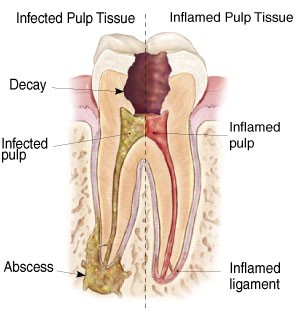 Non-Surgical Root Canal Treatment