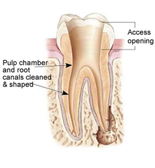 Non-Surgical Root Canal Treatment