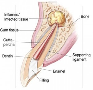 Endodontic Surgery (Apicoectomy)